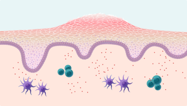 Diagram illustrating how psoriasis can affect the skin as well as immune cell activation below the skin.